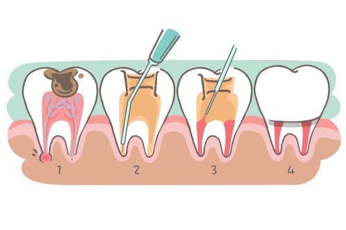 Illustration depicting a pulpotomy procedure on a baby tooth.