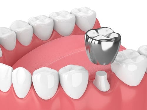 An illustration showing stainless steel and aesthetic strip crowns used in dental restoration.