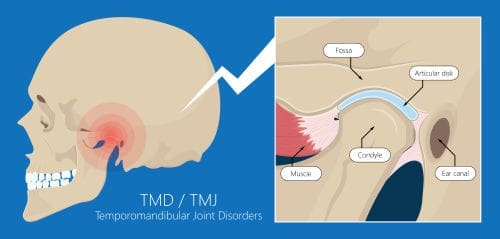 TMD Treatment
