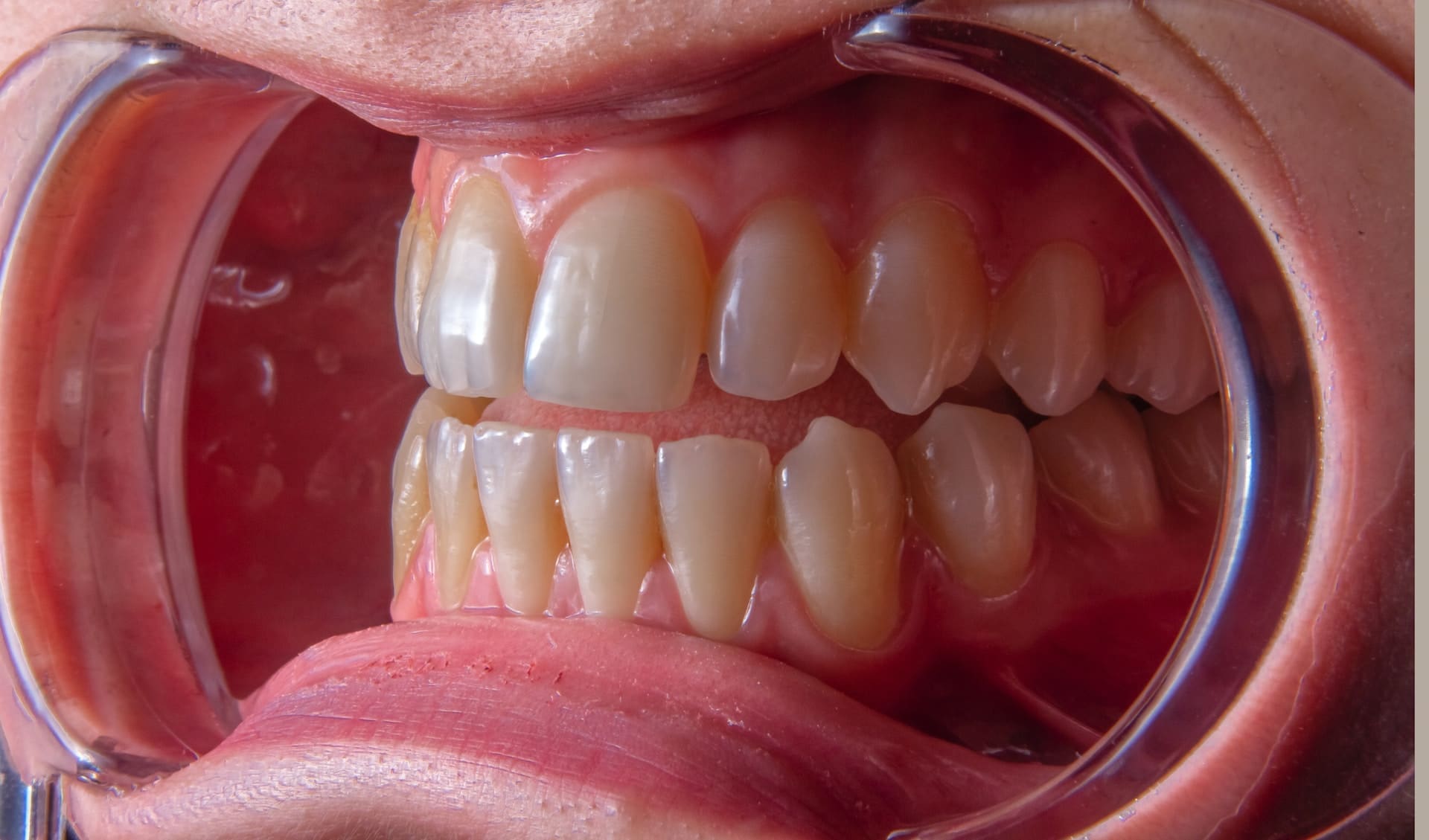 A dental filling procedure being performed at Waban Dental Group in Newton, MA.