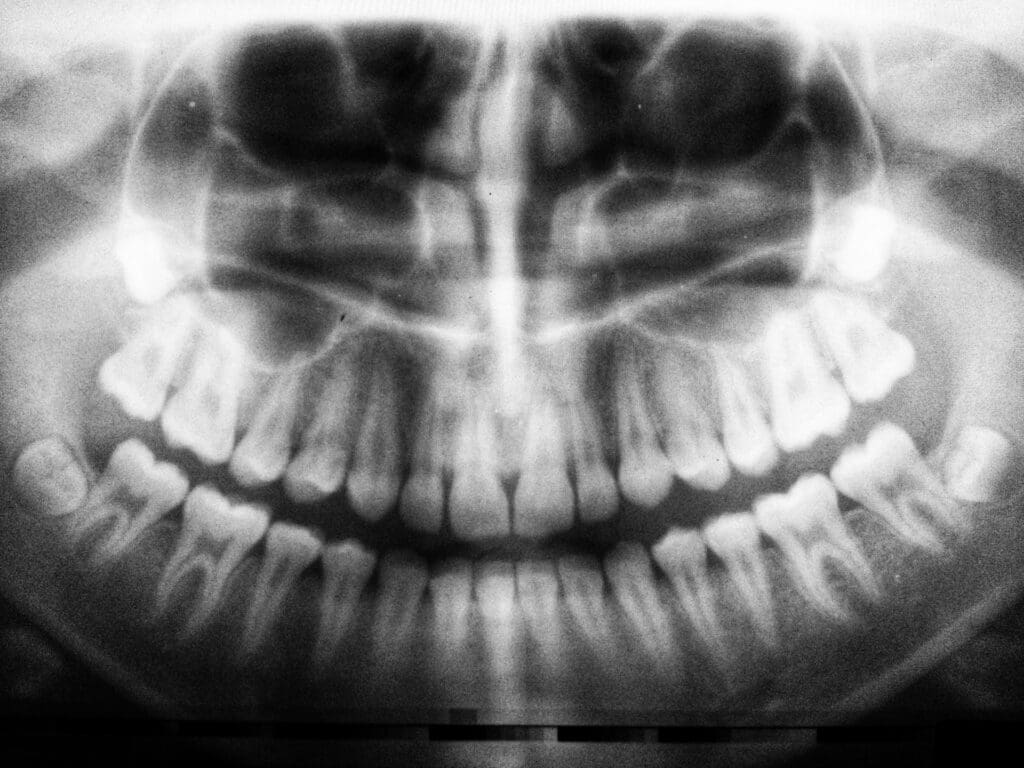 Understanding Dental X-rays: A Crucial Diagnostic Tool in Dentistry