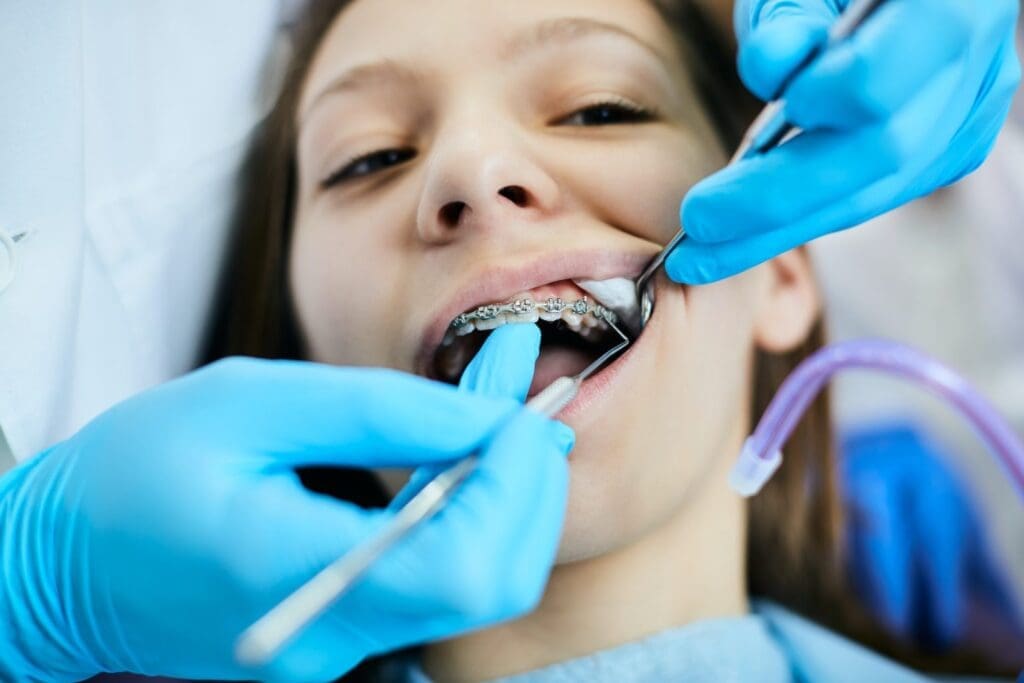 Different types of dental sealants used in children's dentistry.