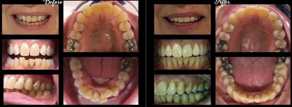 Sealants in Pediatric and Adult Preventive Dentistry