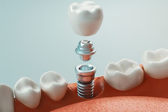A graphic illustration depicting the different parts of dental implants