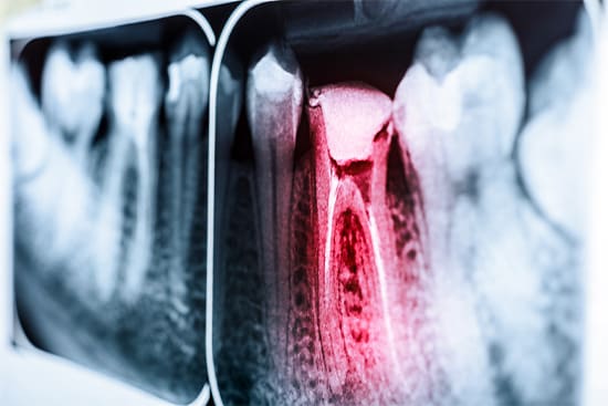 A dental X-ray of an infected tooth