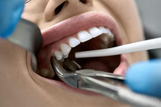 A dentist grabbing a patient’s tooth with dental forceps