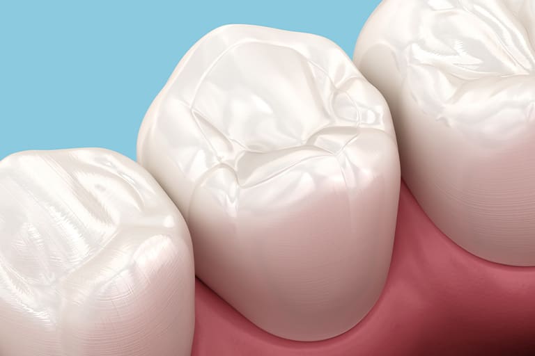 A computer illustration depicting a tooth-colored filling.