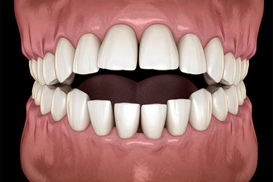 Illustration of an open bite