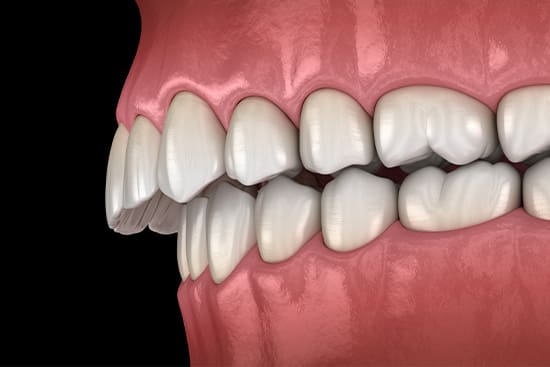 Illustration of an overbite