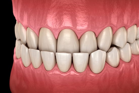 Illustration of an underbite