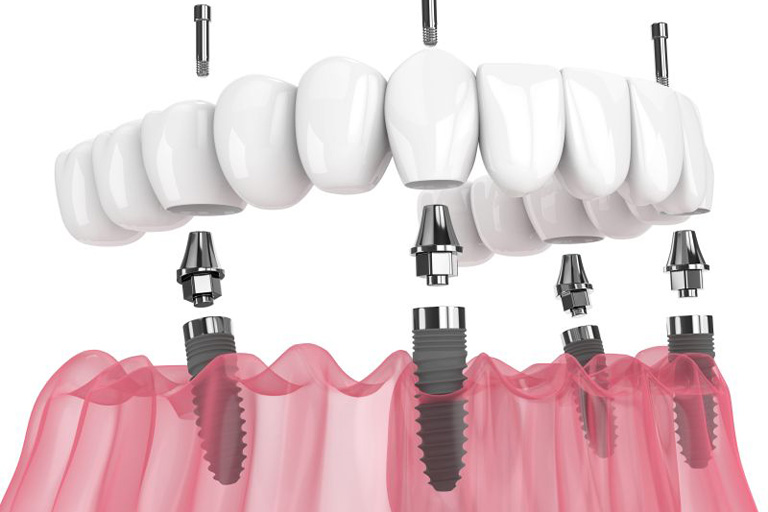 Digital image of All-on-X dental implants.