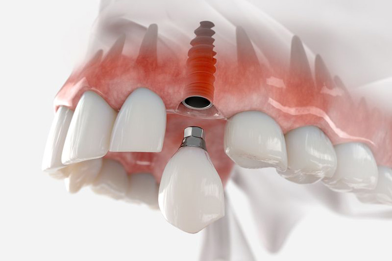 Traditional dental implant in jawbone between natural teeth.