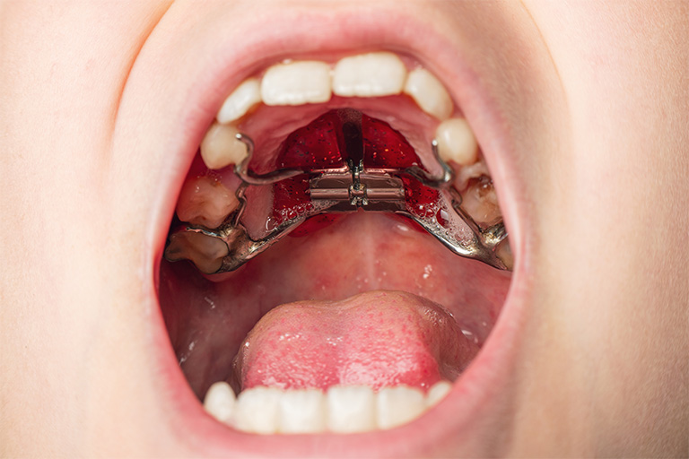 Child with a palatal expander.