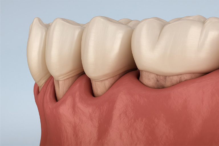 Digital view of gum pockets.