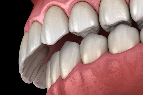 Illustration of overbite.