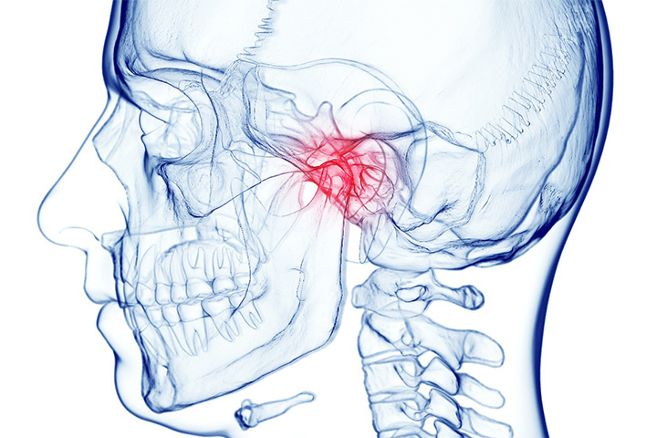 Illustration of skull of person with TMJ disorder in Newton.