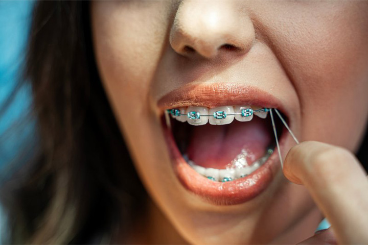 Lady wears braces with elastics.