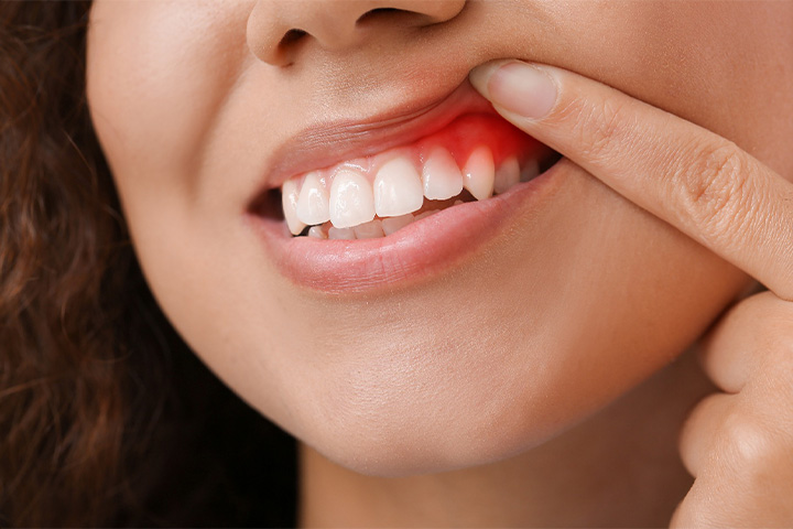 Person holding up their lip to expose red gum tissues.