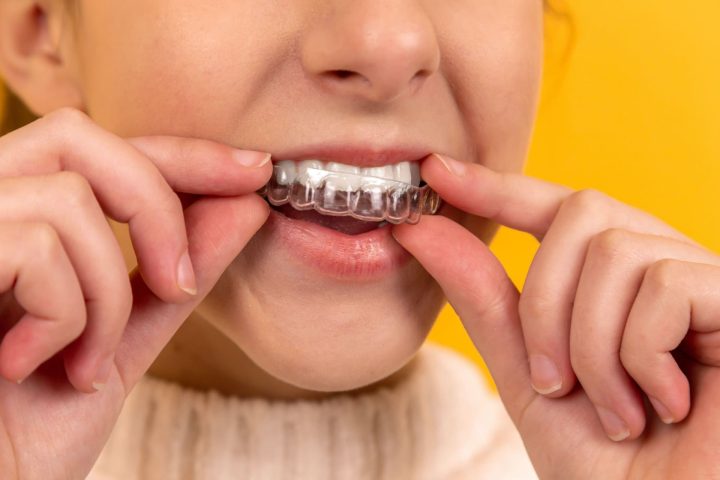 Shield Your Smile: The Role of Dental Sealants and Sports Guards Image highlighting the benefits of Dental Sealants and Sports Guards offered by Waban Dental Group, Newton, MA.