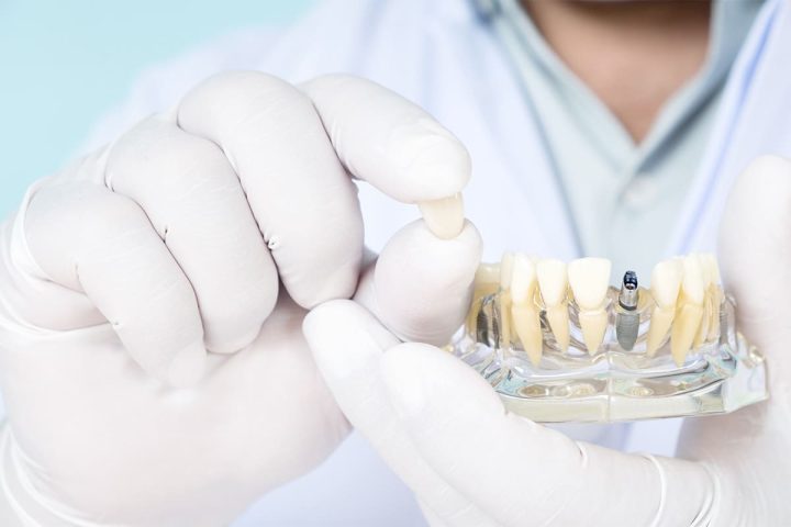 Dentist holding a model of a mouth with a dental crown and a dental implant