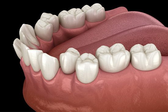 Illustration of crowded teeth.