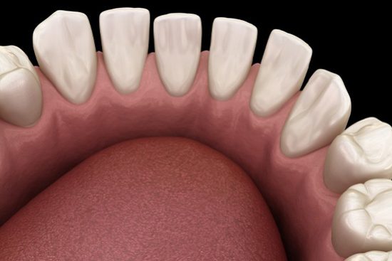 Illustration of teeth with gaps.